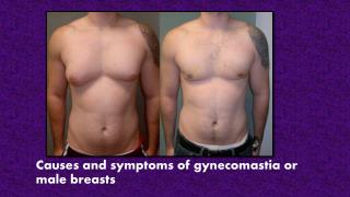 Causes and symptoms of gynecomastia or male breasts