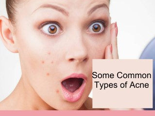 Some Common Types of Acne