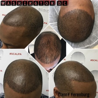 Picture of Hair Loss Tattoo