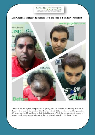 Lost Charm Is Perfectly Reclaimed With the Help of Fue Hair Transplant