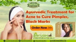 Ayurvedic Treatment for Acne to Cure Pimples, Black Marks