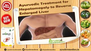 Ayurvedic Treatment for Hepatomegaly to Reverse Enlarged Liver