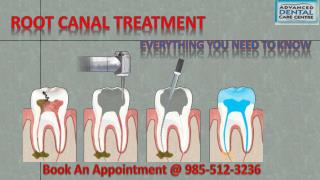 Root Canal Treatment in Tricity