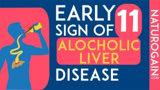 11 Early Signs of Alcoholic Liver Disease