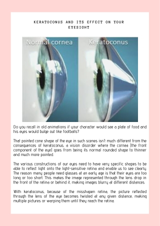 Keratoconus And How does it affect your Eyesight