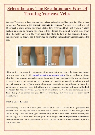 Sclerotherapy The Revolutionary Way Of Treating Varicose Veins
