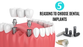 5 Reasons to Choose Dental Implants