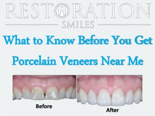 What to Know Before You Get Porcelain Veneers Near Me