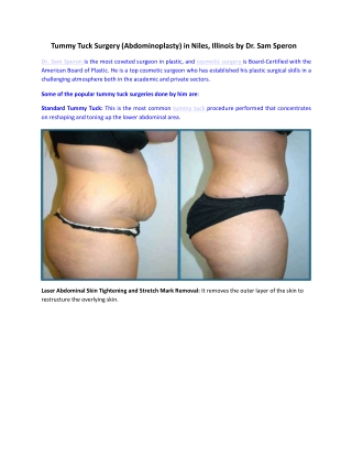 Tummy Tuck Surgery (Abdominoplasty)  in Niles, Illinois by Dr. Sam Speron