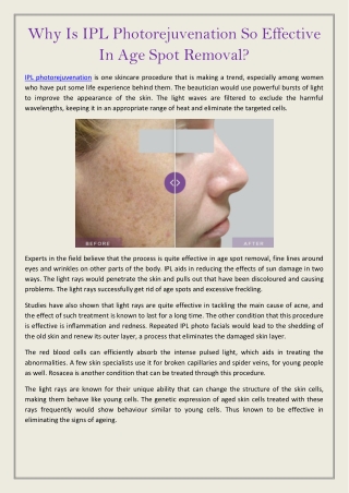 Why Is IPL Photorejuvenation So Effective In Age Spot Removal?