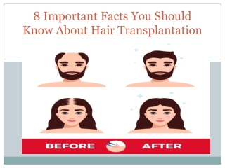 8 Important Facts You Should Know About Hair Transplantation