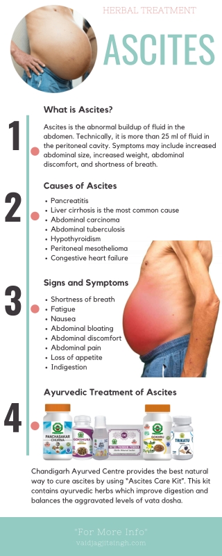 Ascites - Causes, Symptoms and Herbal Treatment