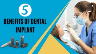 5 Benefits of Dental Implant