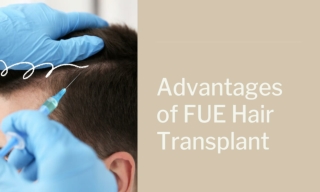 Advantages of FUE Hair Transplant