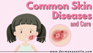 Common Skin Diseases and there Cure by Derma Essentia