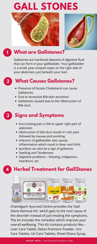 Gall stones - Causes, Symptoms and Herbal Treatment