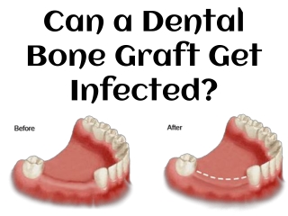 Can a Dental Bone Graft Get Infected?