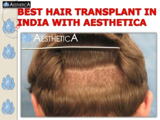 BEST HAIR TRANSPLANT IN INDIA WITH AESTHETICA