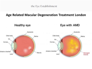 Age Related Macular Degeneration Treatment London