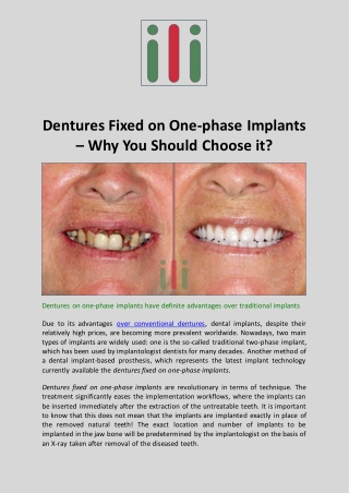 Dentures Fixed on One-phase Implants - Why You Should Choose it?