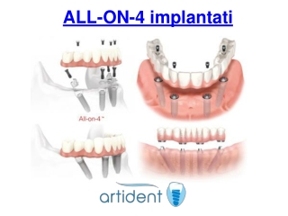 ALL-ON-4 implantati