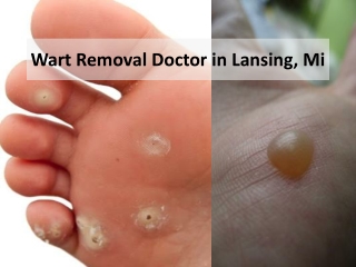 Wart Removal Doctor in Lansing and Mt. Pleasant, Michigan