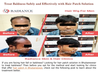 Treat Baldness Safely and Effectively with Hair Patch Solution