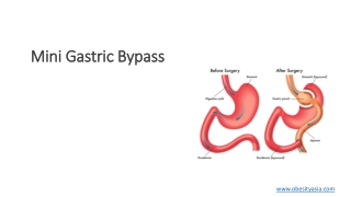 Mini Gastric Bypass/Single anastomosis Gastric By-pass