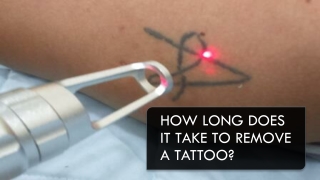 How Long Does it Take to Remove a Tattoo?