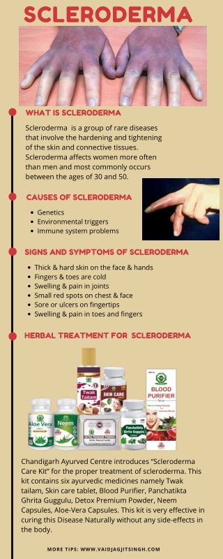 Scleroderma - Causes, Symptoms & Herbal Treatment