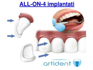 ALL-ON-4 implantati