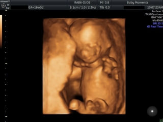 ultrasound of a baby