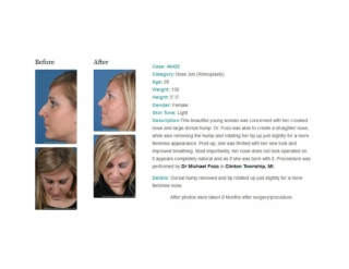 Rhinoplasty Michigan