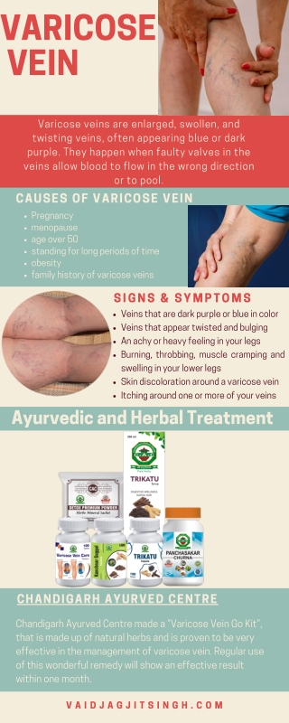 Varicose veins - Causes, Symptoms & Herbal Treatment