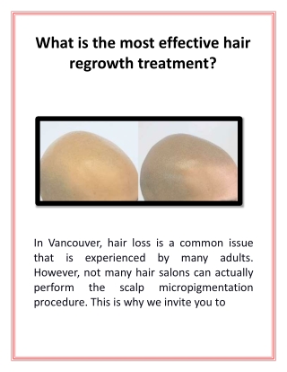 What is the most effective hair regrowth treatment?