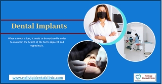 Dental Implants | Dental Implant Treatment in Bangalore