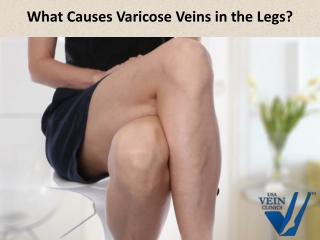 What Causes Varicose Veins in the Legs?