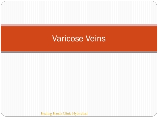 Varicose Veins