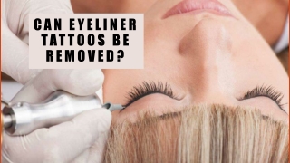 Can Eyeliner Tattoos Be Removed?