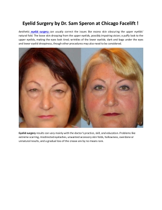 Eyelid Surgery by Dr. Sam Speron at Chicago Facelift