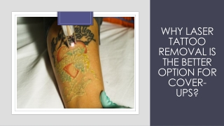 Why Laser Tattoo Removal Is The Better Option For Cover-Ups