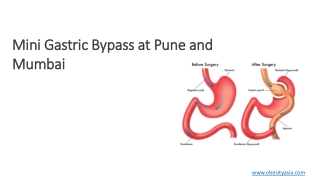 Mini Gastric Bypass/Single anastomosis Gastric By-pass at Pune & Mumbai