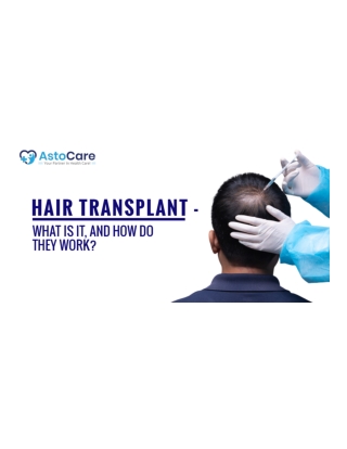 Hair Transplant What Is It And How Do They Work