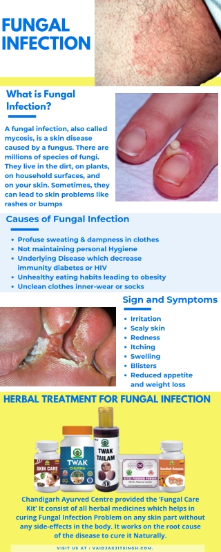 Fungal Infection - Causes, Symptoms & Herbal Treatment