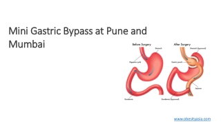 Mini Gastric Bypass/Single anastomosis Gastric By-pass at Pune and Mumbai