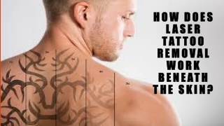 How Does Laser Tattoo Removal Work Beneath The Skin