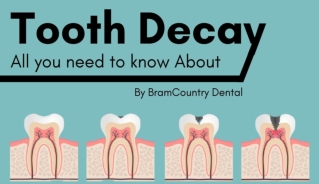 Tooth Decay: All you need to know About by Family Dentist Brampton