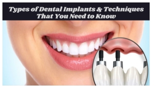 Types of Dental Implants & Techniques That You Need to Know