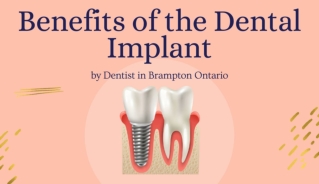 Benefits of the Dental Implant by Dentist in Brampton Ontario