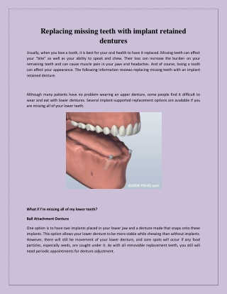 Replacing missing teeth with implant retained dentures